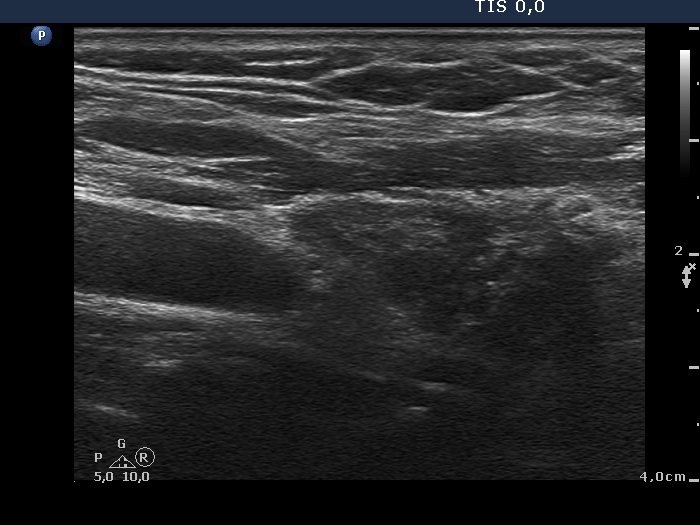 Right lobe, longitudinal scan