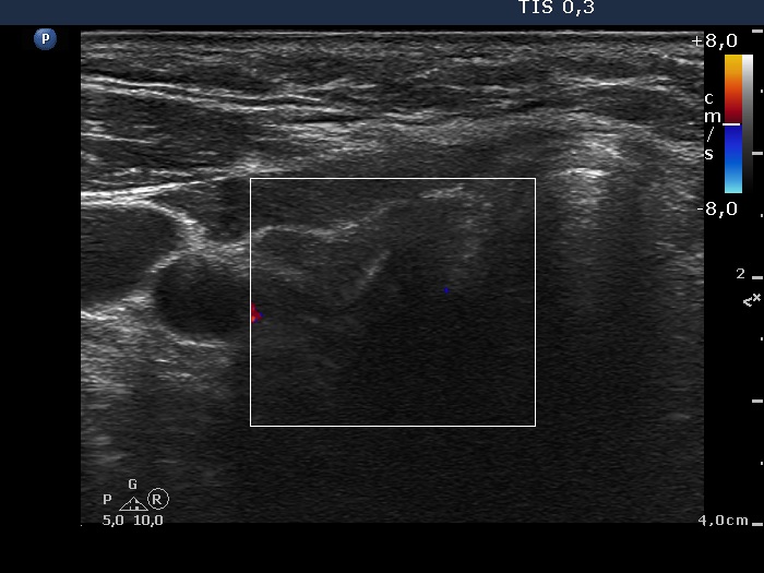 Right lobe, longitudinal scan