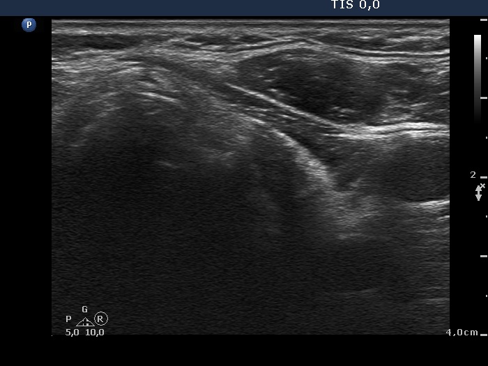 Right lobe, longitudinal scan