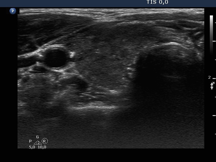 Right lobe, longitudinal scan