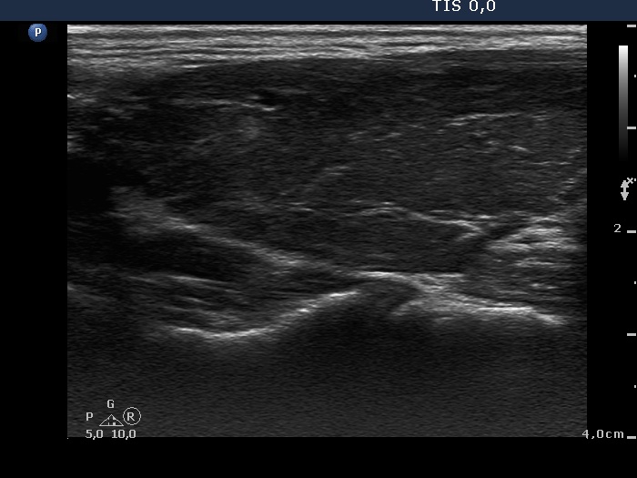Right lobe, longitudinal scan