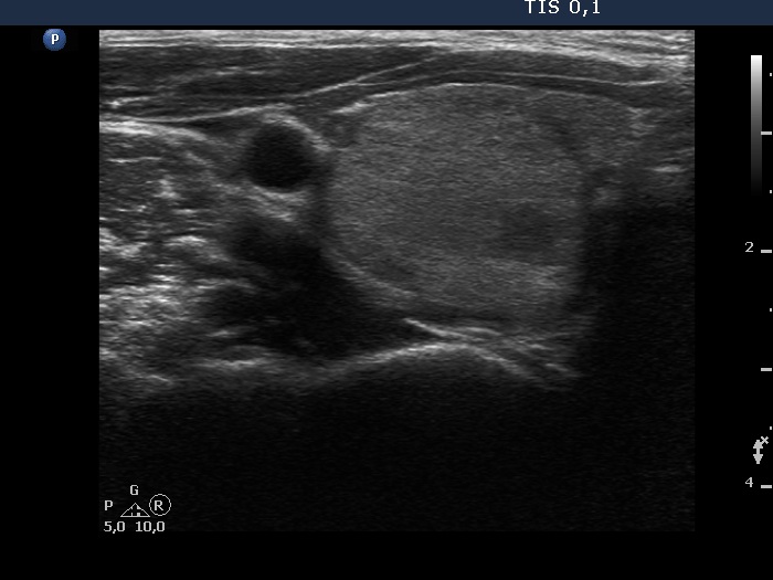 Right lobe, longitudinal scan