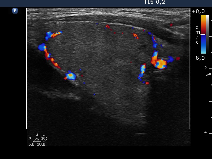 Right lobe, longitudinal scan