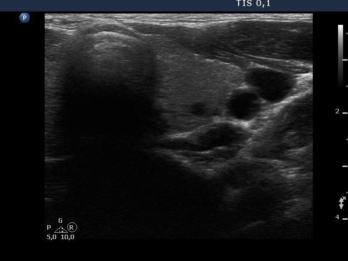 Right lobe, longitudinal scan