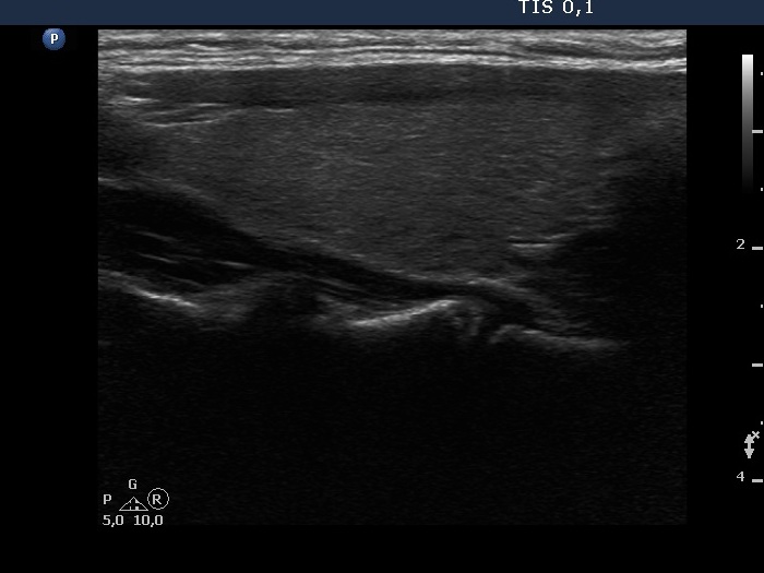 Right lobe, longitudinal scan