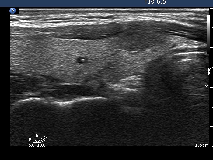 Right lobe, longitudinal scan
