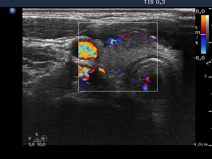 Right lobe, longitudinal scan