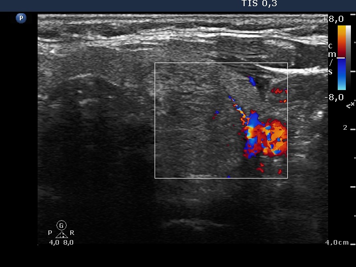 Right lobe, longitudinal scan