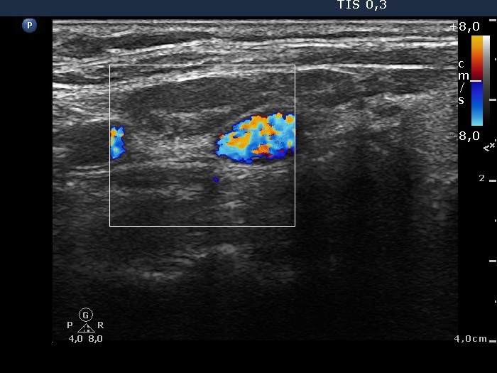 Right lobe, longitudinal scan
