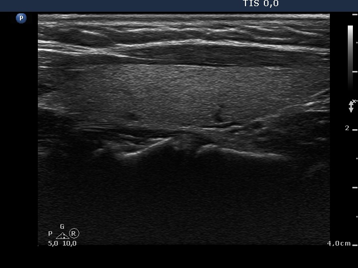 Right lobe, longitudinal scan