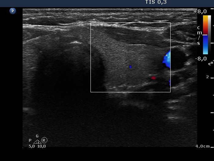 Right lobe, longitudinal scan