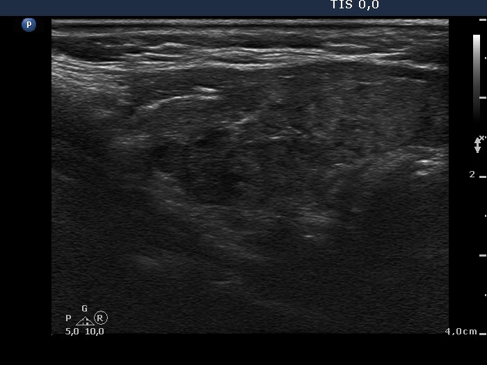 Right lobe, longitudinal scan