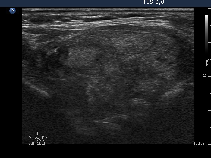 Right lobe, longitudinal scan