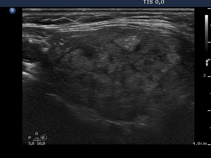 Right lobe, longitudinal scan