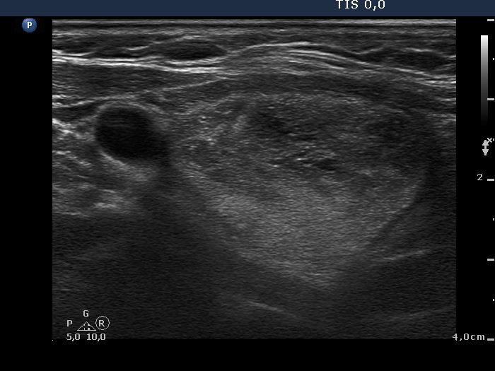 Right lobe, longitudinal scan