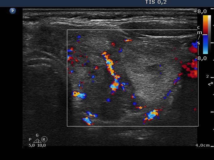 Right lobe, longitudinal scan