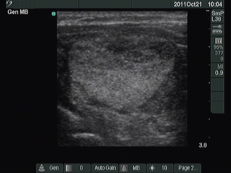 Right lobe, longitudinal scan