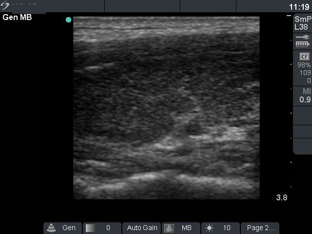 Right lobe, longitudinal scan