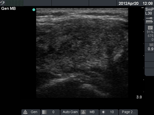 Right lobe, longitudinal scan