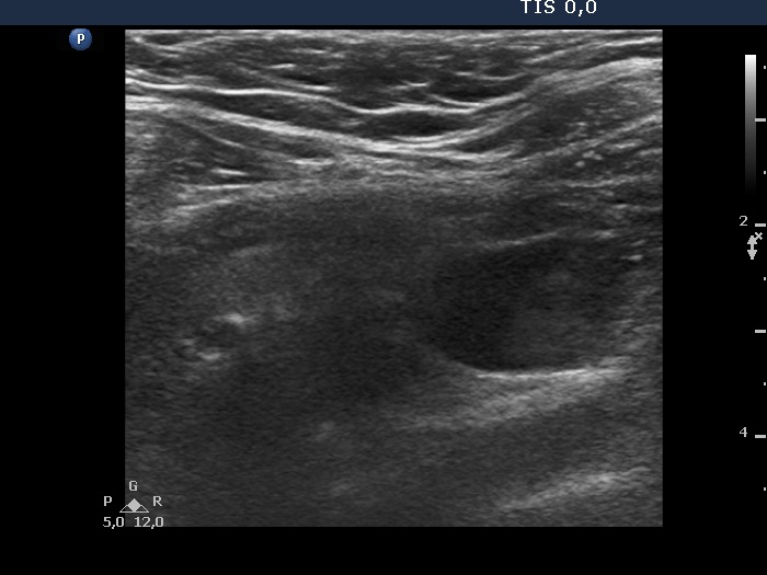 Right lobe, longitudinal scan