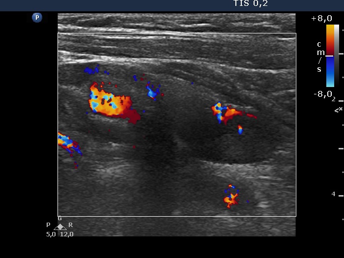 Right lobe, longitudinal scan
