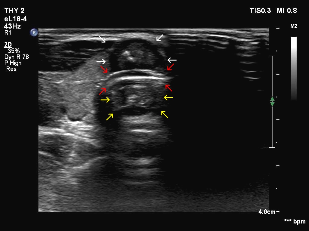 Right lobe, longitudinal scan