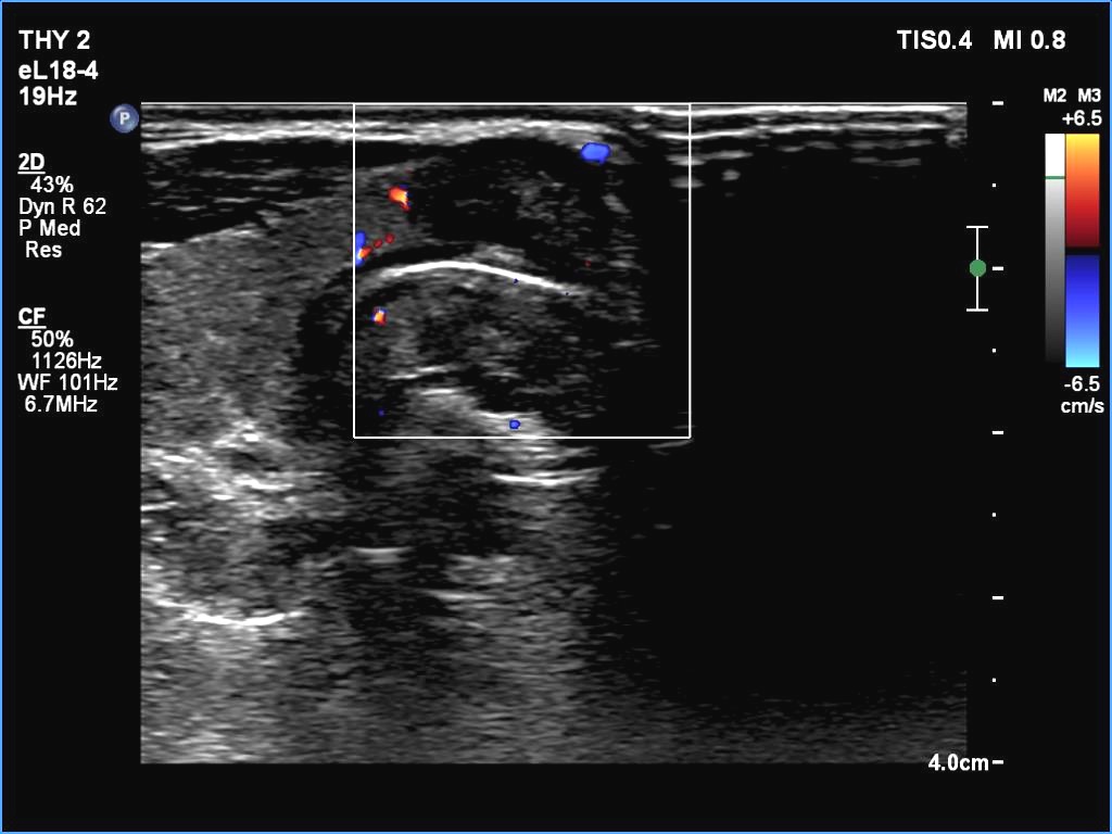 Right lobe, longitudinal scan
