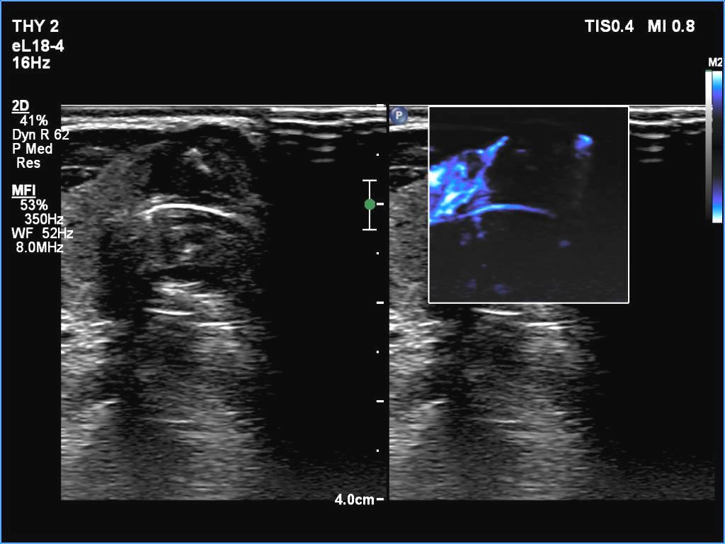 Right lobe, longitudinal scan