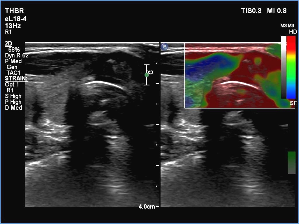 Right lobe, longitudinal scan