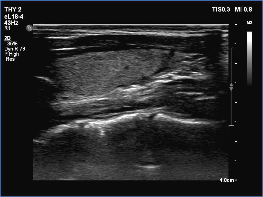Right lobe, longitudinal scan