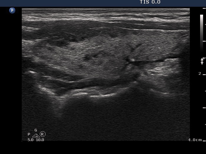 Right lobe, longitudinal scan