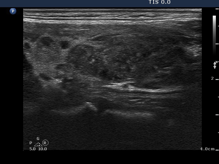 Right lobe, longitudinal scan