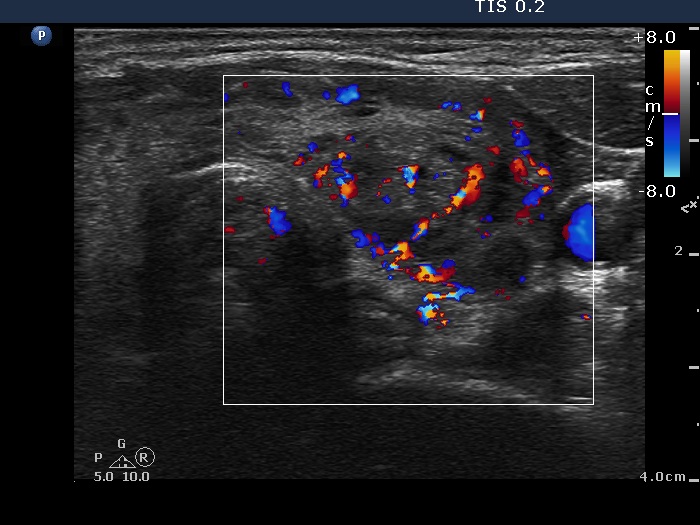 Right lobe, longitudinal scan