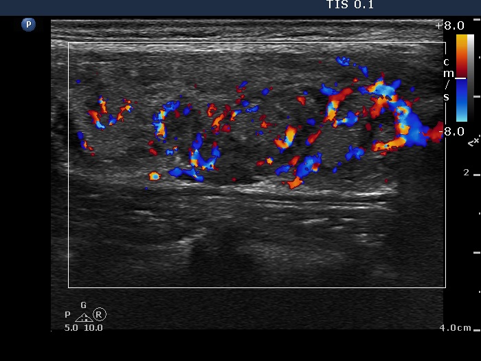 Right lobe, longitudinal scan