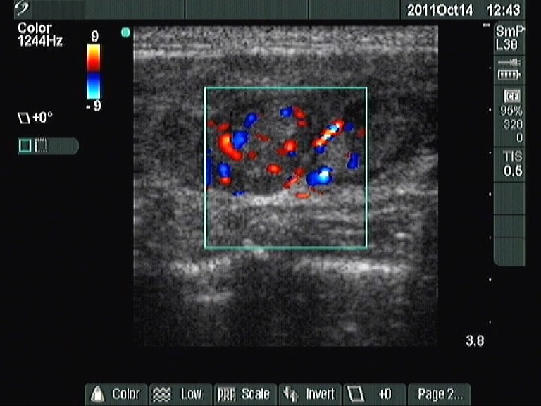 Right lobe, longitudinal scan
