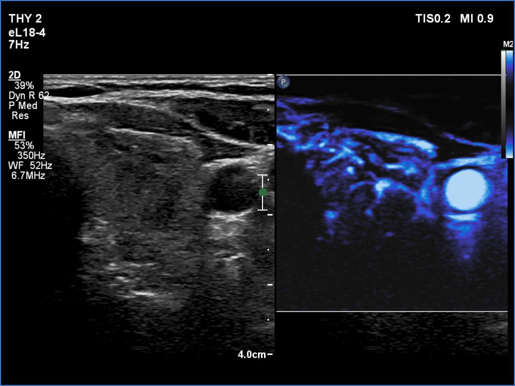 Right lobe, longitudinal scan