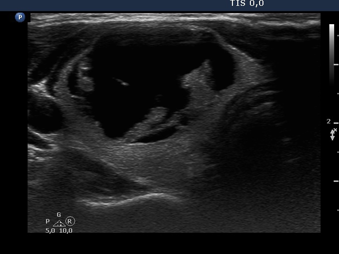 Right lobe, longitudinal scan