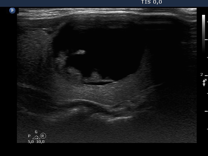 Right lobe, longitudinal scan