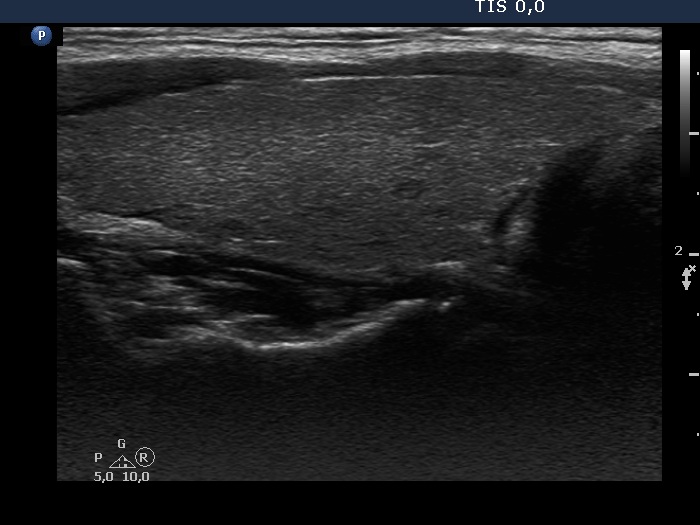 Right lobe, longitudinal scan
