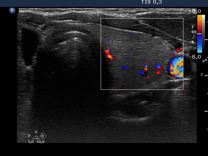 Right lobe, longitudinal scan