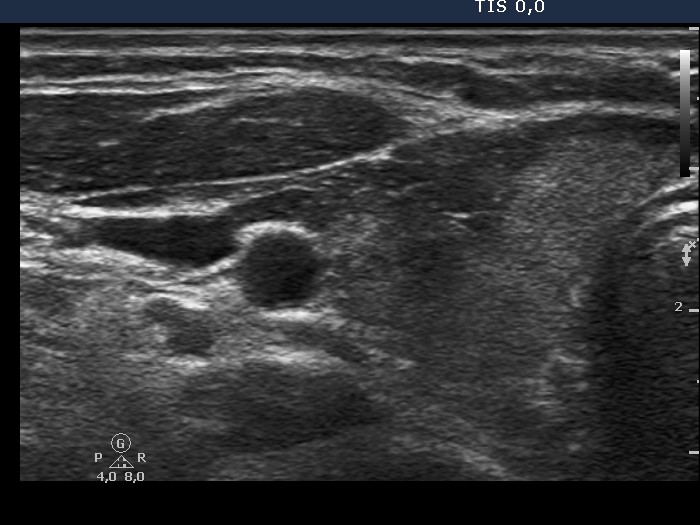 Right lobe, longitudinal scan
