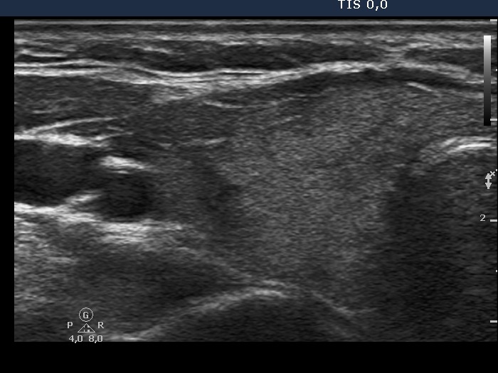 Right lobe, longitudinal scan