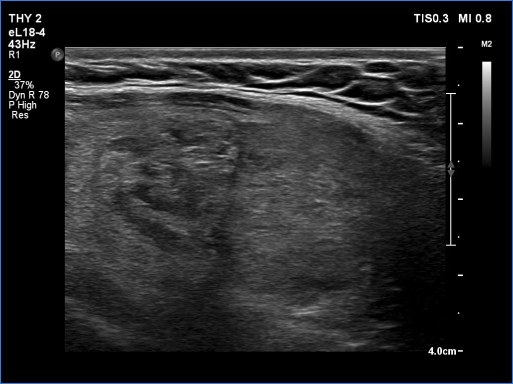 Right lobe, longitudinal scan