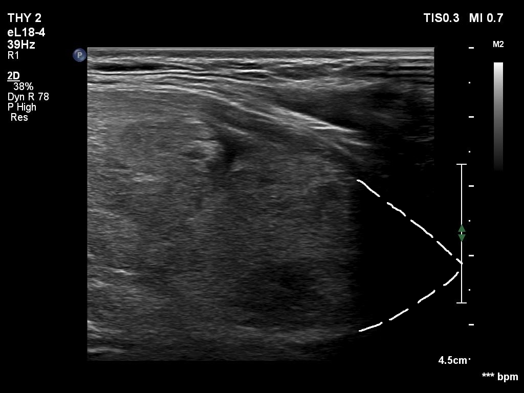 Right lobe, longitudinal scan