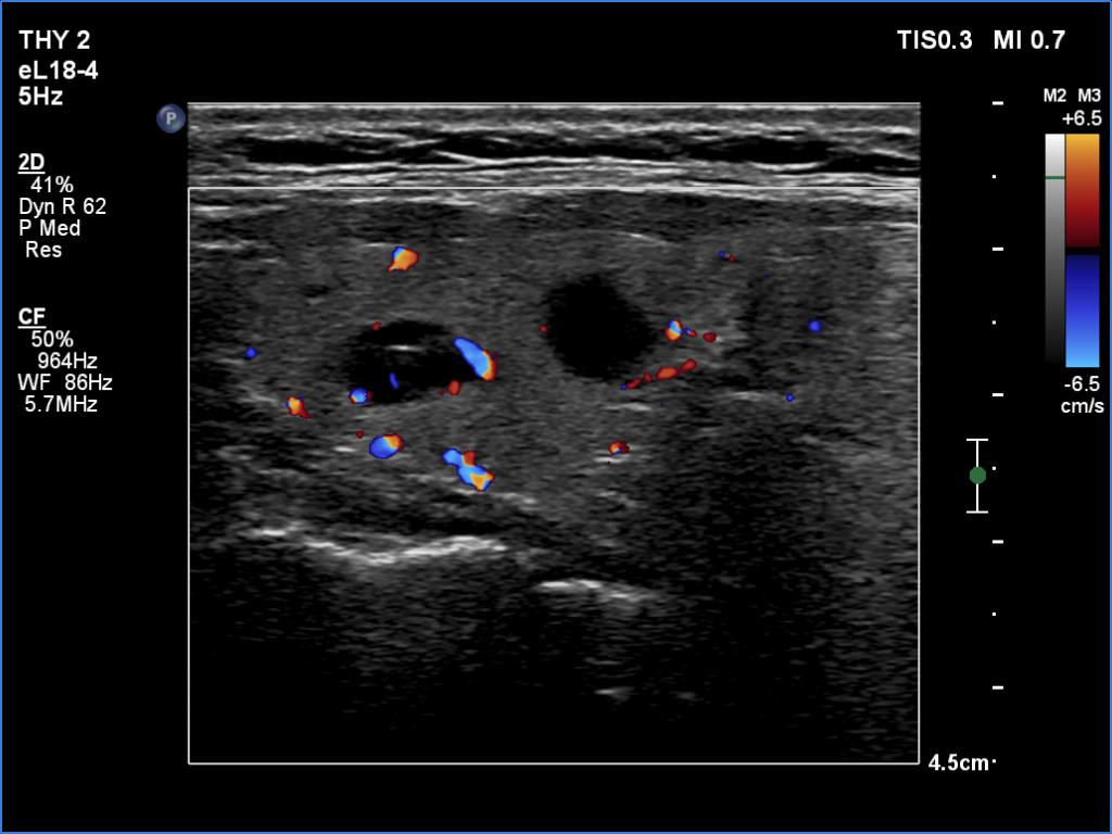 Right lobe, longitudinal scan