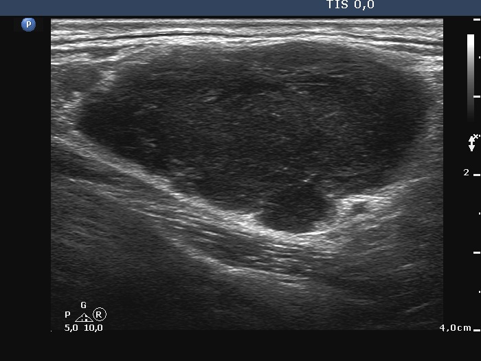 Right lobe, longitudinal scan