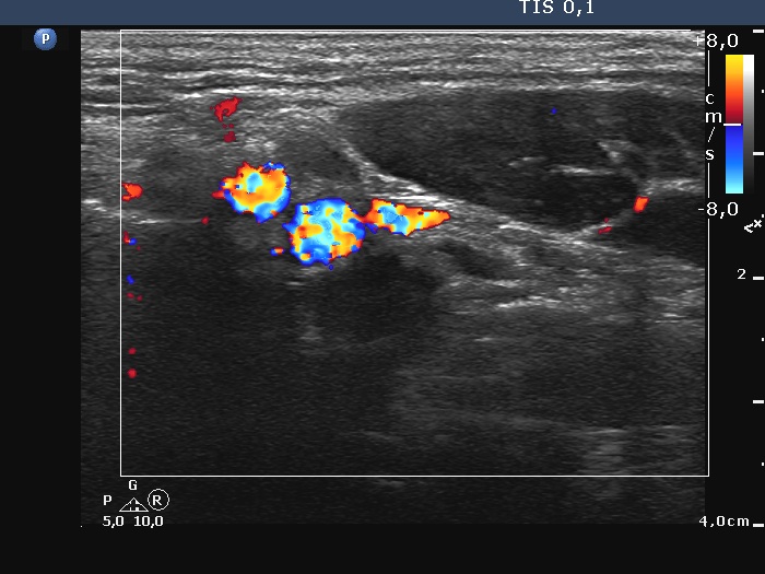 Right lobe, longitudinal scan