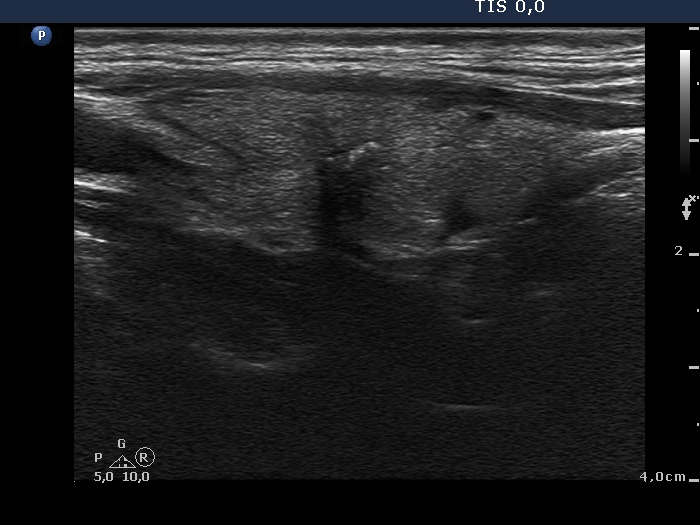 Right lobe, longitudinal scan