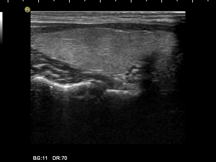 Right lobe, longitudinal scan