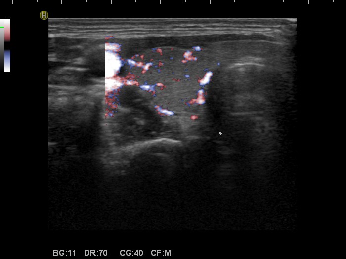 Right lobe, longitudinal scan